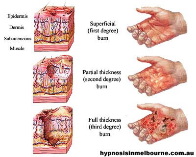 burn-classification