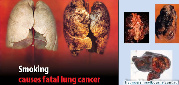 lung_disease